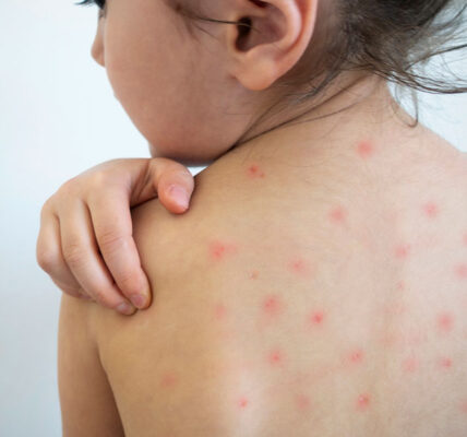 Refuerzan estrategias contra el sarampión, después que Puerto Vallarta tuvo un caso en 2025